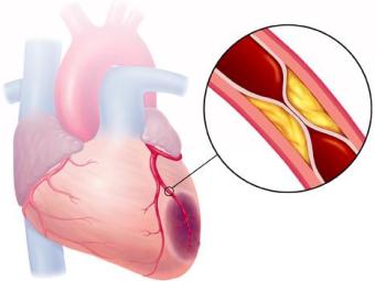 Інфаркт міокарда лікування народними методами